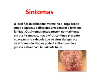 SintomasO local fica inicialmente  vermelho e  coça depois surge pequenas bolhas que arrebentam e formam  feridas . Os sintomas desaparecem normalmente em ate 4 semanas, mas o vírus continua presente no organismo e depois que ao vírus desaparece os sintomas do Herpes poderá voltar quando a pessoa estiver com imunidade baixa.