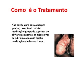 Como  é o Tratamento Não existe cura para o herpes genital, no entanto existe medicação que pode suprimir ou aliviar os sintomas. O médico vai decidir em cada caso qual a medicação ela devera tomar.
