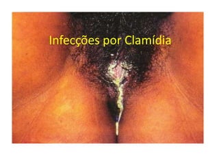 Infecções por Clamídia