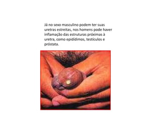 Já no sexo masculino podem ter suas uretras estreitas, nos homens pode haver inflamação das estruturas próximas à uretra, como epidídimos, testículos e próstata. 