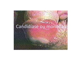 Candidíase ou monolíase