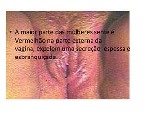 A maior parte das mulheres sente é Vermelhão na parte externa da vagina, expelem uma secreção  espessa e esbranquiçada. 