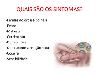 QUAIS SÃO OS SINTOMAS?
-Feridas dolorosas(bolhas)
-Febre
-Mal estar
-Corrimento
-Dor ao urinar
-Dor durante a relação sexual
-Coceira
-Sensibilidade
 