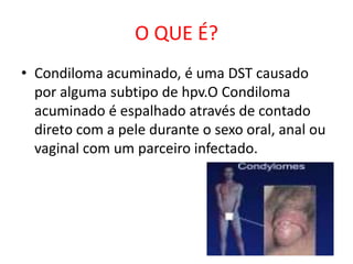 O QUE É?
• Condiloma acuminado, é uma DST causado
  por alguma subtipo de hpv.O Condiloma
  acuminado é espalhado através de contado
  direto com a pele durante o sexo oral, anal ou
  vaginal com um parceiro infectado.
 