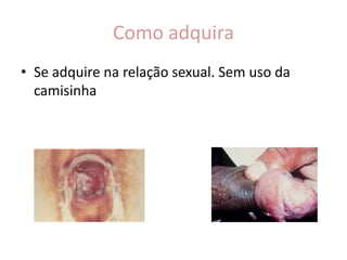 Como adquira
• Se adquire na relação sexual. Sem uso da
  camisinha
 