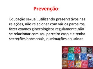 Prevenção:
Educação sexual, utilizando preservativos nas
relações, não relacionar com vários parceiros,
fazer exames ginecológicos regulamente,não
se relacionar com seu parceiro caso ele tenha
secreções hormonais, queimações ao urinar.
 