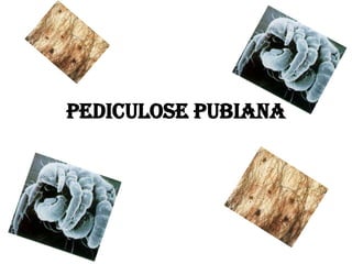 Pediculose pubiana
 