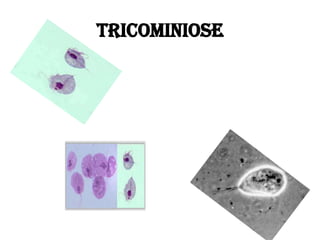 Tricominiose
 