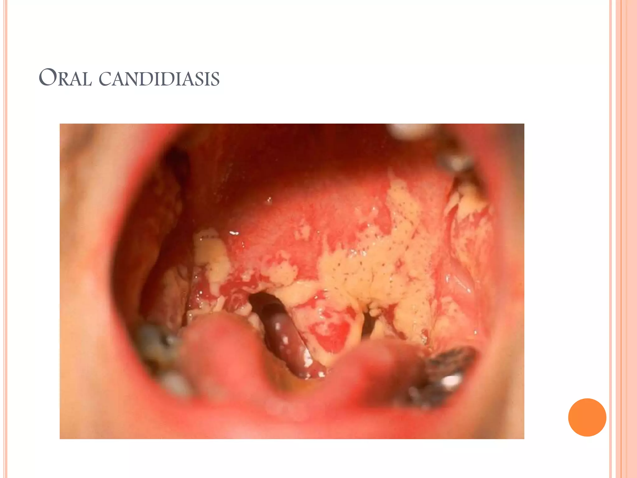 ORAL CANDIDIASIS

 