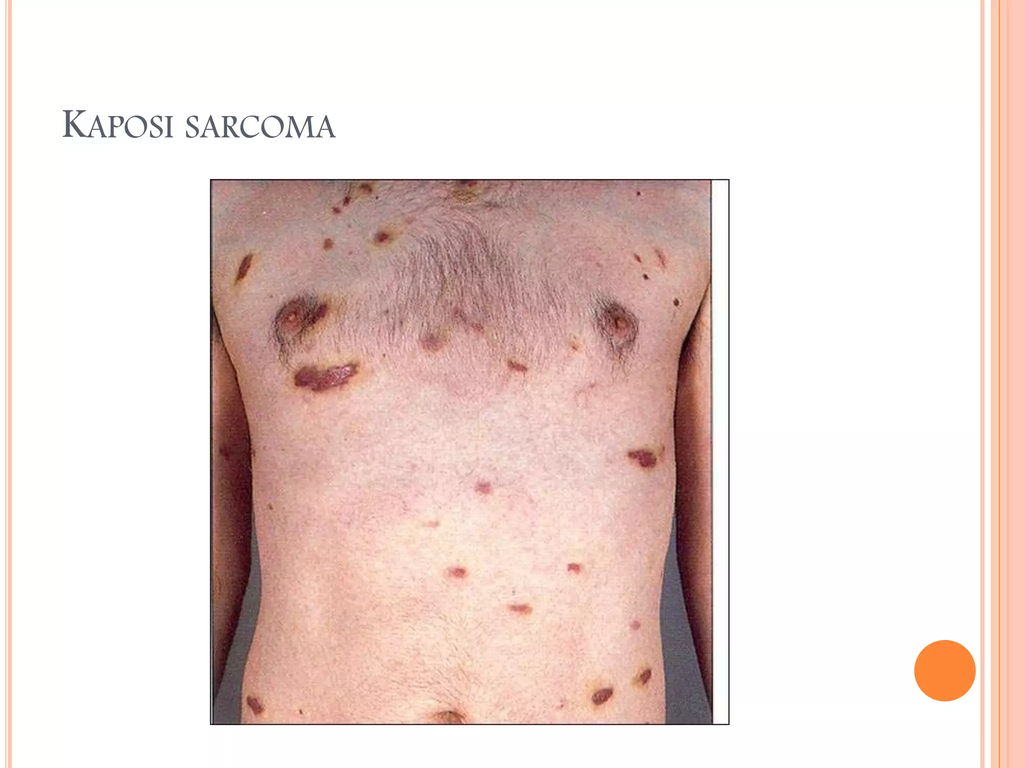 KAPOSI SARCOMA

 