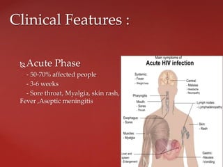 Acute Phase
- 50-70% affected people
- 3-6 weeks
- Sore throat, Myalgia, skin rash,
Fever ,Aseptic meningitis
Clinical Features :
 