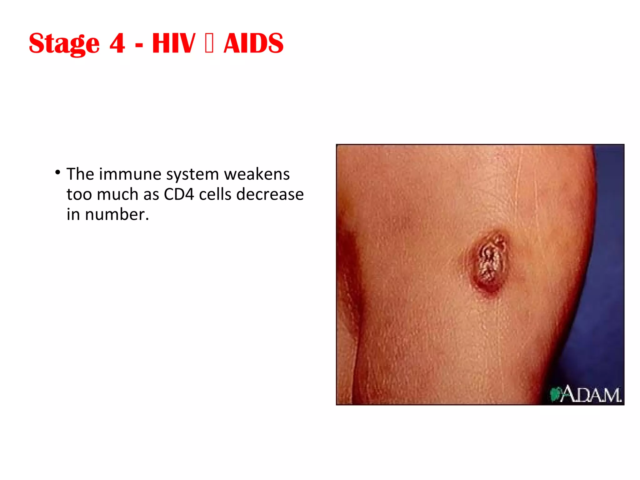 Stage 4 - HIV  AIDS
• The immune system weakens
too much as CD4 cells decrease
in number.
 