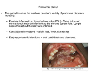 Prodromal phase
• This period involves the insidious onset of a variety of prodromal disorders,
including:
– Persistent Generalized Lymphadenopathy (PGL) - There is loss of
normal lymph node architecture as the immune system fails. Lymph
nodes throughout the body are enlarged.
– Constitutional symptoms - weight loss, fever, skin rashes
– Early opportunistic infections - oral candidiasis and diarrhoea.
Fig. 5.2: Oro-pharyngeal candidiasis in an HIV positive person
 