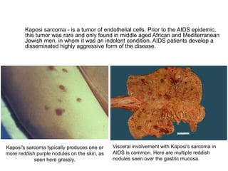 Kaposi's sarcoma typically produces one or
more reddish purple nodules on the skin, as
seen here grossly.
Visceral involvement with Kaposi's sarcoma in
AIDS is common. Here are multiple reddish
nodules seen over the gastric mucosa.
Kaposi sarcoma - is a tumor of endothelial cells. Prior to the AIDS epidemic,
this tumor was rare and only found in middle aged African and Mediterranean
Jewish men, in whom it was an indolent condition. AIDS patients develop a
disseminated highly aggressive form of the disease.
 