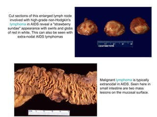 Cut sections of this enlarged lymph node
involved with high-grade non-Hodgkin's
lymphoma in AIDS reveal a "strawberry
sundae" appearance with swirls and globs
of red in white. This can also be seen with
extra-nodal AIDS lymphomas
Malignant lymphoma is typically
extranodal in AIDS. Seen here in
small intestine are two mass
lesions on the mucosal surface.
 