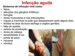 Infecção aguda   Sintomas de infecção viral como: febre; afecções dos gânglios linfáticos; faringite; dores musculares e nas articulações; ínguas e manchas na pele que desaparecem após alguns dias;  feridas na área da boca esôfago e órgãos genitais;  falta de apetite;  estado de prostração;  dores de cabeça; sensibilidade à luz;  perda de peso; náuseas vômitos.  E E 