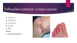 Infecções comuns e suas causas
 Pneumonia
 Herpesvírus
 Tuberculose
 Micoses
 Sífilis
Causas:
 Diminuição de TCD4
 