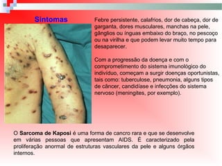 Sintomas Febre persistente, calafrios, dor de cabeça, dor de
garganta, dores musculares, manchas na pele,
gânglios ou ínguas embaixo do braço, no pescoço
ou na virilha e que podem levar muito tempo para
desaparecer.
Com a progressão da doença e com o
comprometimento do sistema imunológico do
indivíduo, começam a surgir doenças oportunistas,
tais como: tuberculose, pneumonia, alguns tipos
de câncer, candidíase e infecções do sistema
nervoso (meningites, por exemplo).
O Sarcoma de Kaposi é uma forma de cancro rara e que se desenvolve
em várias pessoas que apresentam AIDS. É caracterizado pela
proliferação anormal de estruturas vasculares da pele e alguns órgãos
internos.
 