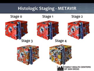 Histologic Staging - METAVIR
No Fibrosis Portal Fibrosis Few septa
Stage 0 Stage 1 Stage 2
Numerous septa
Stage 3
Cirrhosis
Stage 4
 