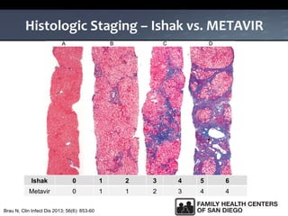 Histologic Staging – Ishak vs. METAVIR
Ishak 0 1 2 3 4 5 6
Metavir 0 1 1 2 3 4 4
Brau N, Clin Infect Dis 2013; 56(6): 853-60
 