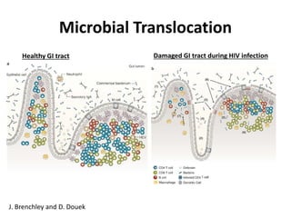 Microbial Translocation
J. Brenchley and D. Douek
Healthy GI tract Damaged GI tract during HIV infection
 