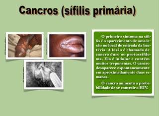 CDC/Domíniopúblico
CDC/Domíniopúblico
CDC/Domíniopúblico
O primeiro sintoma na síﬁ-
lis é o aparecimento de uma le-
são no local de entrada da bac-
téria. A lesão é chamada de
cancro duro ou protossiﬁlo-
ma. Ela é indolor e contém
muitos treponemas. O cancro
desaparece espontaneamente
em aproximadamente duas se-
manas.
O cancro aumenta a proba-
bilidade de se contrair o HIV.
 
