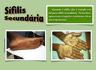 CDC/Domíniopúblico
CDC/Domíniopúblico
Quando a síﬁlis não é tratada evo-
lui para síﬁlis secundária. Nesta fase,
aparecem erupções cutâneas ricas
em treponemas.
 