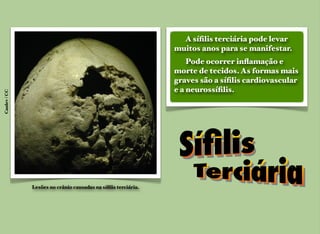 A síﬁlis terciária pode levar
muitos anos para se manifestar.
Pode ocorrer inﬂamação e
morte de tecidos. As formas mais
graves são a síﬁlis cardiovascular
e a neurossíﬁlis.
Canlev/CC
Lesões no crânio causadas na síﬁlis terciária.
 