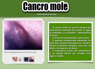! O cancro mole ou cancro venéreo po-
pularmente chamado de cavalo. O agen-
te etiológico é a bactéria Haemophilus
ducreyi.
! A forma de transmissão é pelo sexo.
! A pessoa contaminada apresenta nu-
merosas úlceras dolorosas em número,
forma e tamanho variados, com pus no
pênis, na vagina e no ânus.
! O tratamento é feito com antibióticos
e as lesões devem ser lavadas com
água e sabão.
Úlcera na região genital (imagem: CDC/Domínio público)
Haemophilus ducreyi
 