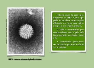 LaboratoryofTumorVirusBiology/Domíniopúblico
HPV visto ao microscópio eletrônico.
	

 Existem mais de cem tipos
diferentes de HPV. Cada tipo
pode se localizar numa região
diferente do corpo nas mãos,
nos pés e nos órgãos genitais.
	

 O HPV é transmitido por
contato direto com a pele infe-
tada, durante as relações sexu-
ais.
	

 A transmissão pode ocor-
rer durante o parto se a mãe ti-
ver a infeção.
 