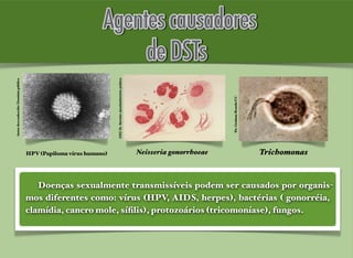Autordesconhecido/Domíniopúblico
HPV (Papiloma vírus humano) Neisseria gonorrhoeae
CDC/Dr.NormanJacobs/domíniopúblico
Trichomonas
Dr.GrahamBeards/CC
Doenças sexualmente transmissíveis podem ser causados por organis-
mos diferentes como: vírus (HPV, AIDS, herpes), bactérias ( gonorréia,
clamídia, cancro mole, síﬁlis), protozoários (tricomoníase), fungos.
 