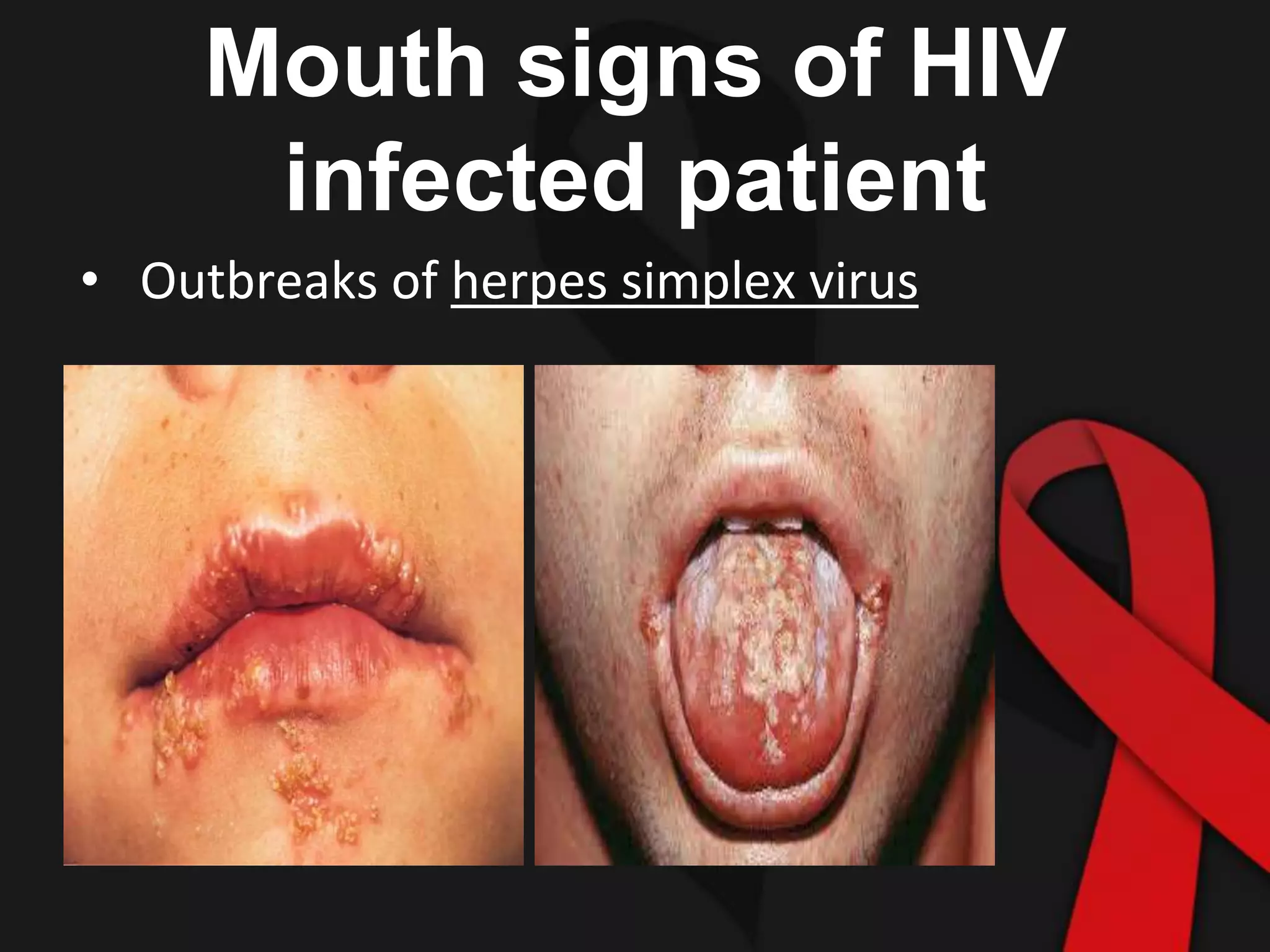 Aids For Dental Students PPTX