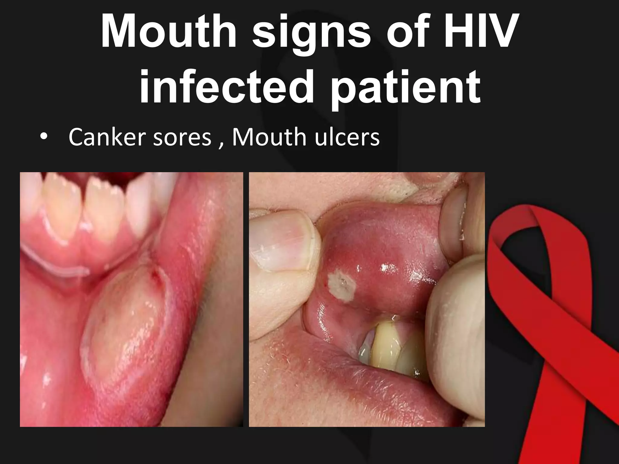 Aids For Dental Students PPTX