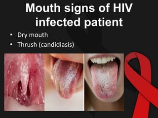 Aids For Dental Students PPTX