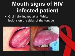 Mouth signs of HIV
infected patient
• Oral hairy leukoplakia : White
lesions on the sides of the tongue
 