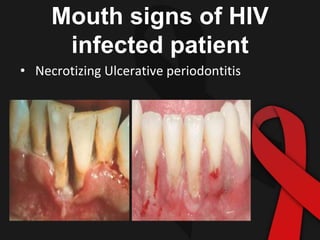Mouth signs of HIV
infected patient
• Necrotizing Ulcerative periodontitis
 