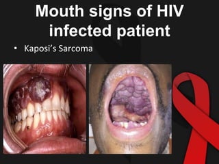 Mouth signs of HIV
infected patient
• Kaposi’s Sarcoma
 