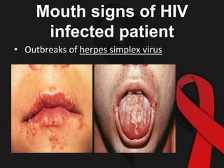 Mouth signs of HIV
infected patient
• Outbreaks of herpes simplex virus
 