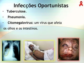 Infecções Oportunistas
• Tuberculose.
•   Pneumonia.
•   Citomegalovírus: um vírus que afeta
os olhos e os intestinos.
 