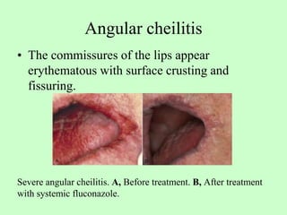 AIDS and its effect on Periodontium A look into the role .ppt