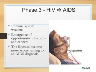 Phase 3 - HIV  AIDS
• Immune system
weakens
• Emergence of
opportunistic infections
and cancers
• The illnesses become
more severe leading to
an AIDS diagnosis
 
