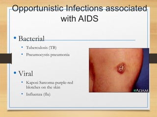 Opportunistic Infections associated
with AIDS
• Bacterial
• Tuberculosis (TB)
• Pneumocystis pneumonia
• Viral
• Kaposi Sarcoma-purple-red
blotches on the skin
• Influenza (flu)
 