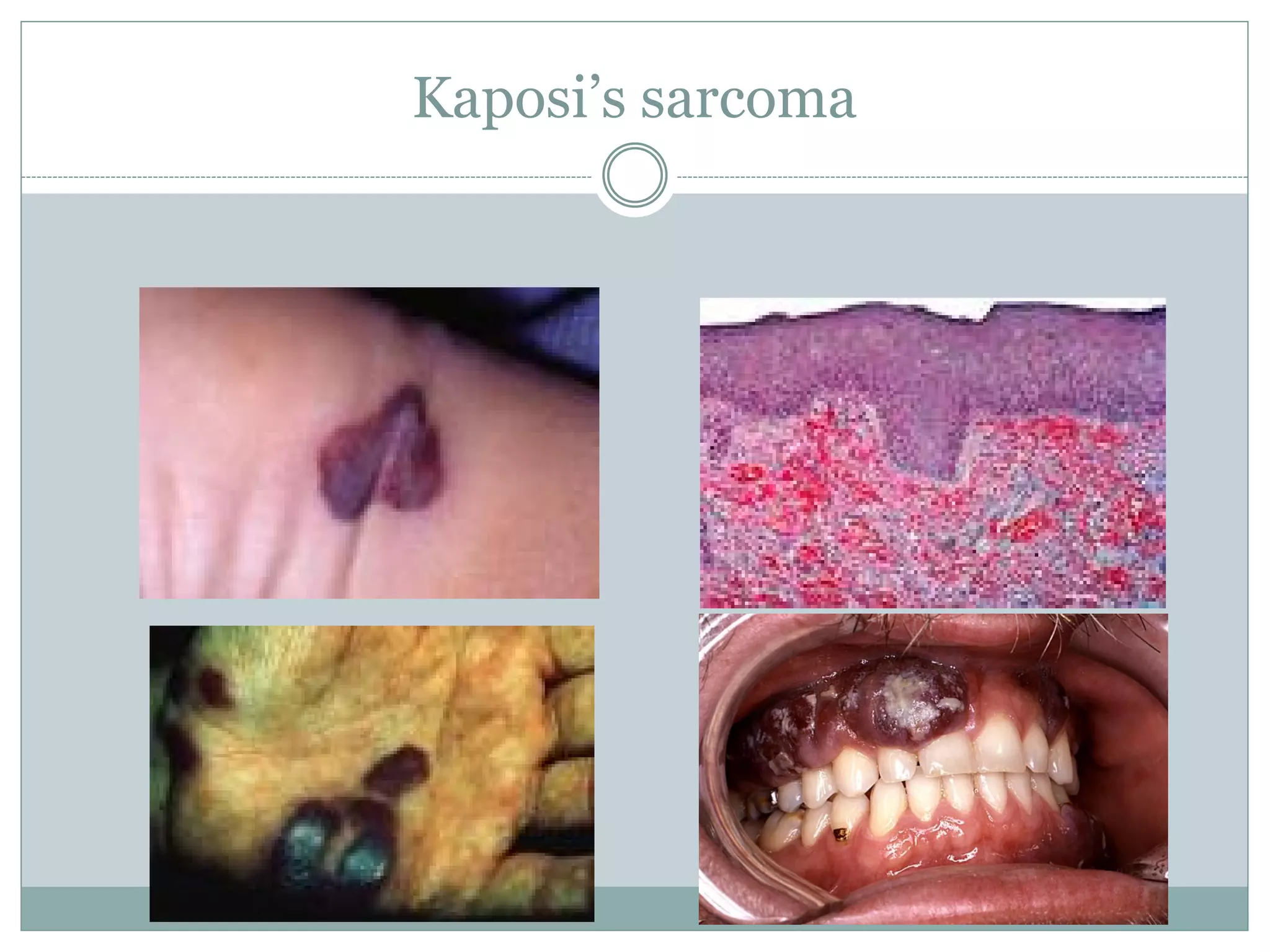 Kaposi’s sarcoma
 