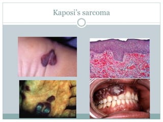 Kaposi’s sarcoma
 