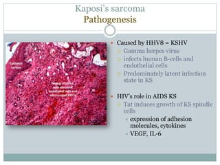Kaposi’s sarcoma
Pathogenesis
 Caused by HHV8 = KSHV
 Gamma herpes virus
 infects human B-cells and
endothelial cells
 Predominately latent infection
state in KS
 HIV’s role in AIDS KS
 Tat induces growth of KS spindle
cells
 expression of adhesion
molecules, cytokines
 VEGF, IL-6
 