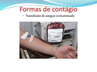 Formas de contágio
• Transfusão de sangue contaminado

 