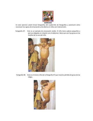 EJERCICIO
En este ejercicio usted mirará fotografías del cuadernillo de fotografías y practicará cómo
reconocer los signos de emaciación y de edema en niños con malnutrición.
Fotografía 47: Este es un ejemplo de emaciación visible. El niño tiene caderas pequeñas y
piernas delgadas en relación con el abdomen. Note que aún hay grasa en las
mejillas de la cara del niño.
Fotografía 48: Este es el mismo niño de la fotografía 47 que muestra pérdida de grasa de las
nalgas.
 