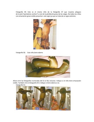 Fotografía 49: Este es el mismo niño de la fotografía 47 que muestra pliegues
de la piel ("pantalones anchos") a raíz de la pérdida de grasa de las nalgas. No todos los niños
con emaciación grave visible presentan este signo ya que se trata de un signo extremo.
Fotografía 50. Este niño tiene edema
Ahora mire las fotografías numeradas del 51 al 58, inclusive. Indique si el niño tiene emaciación
visible. También mire la fotografía 59 e indique si tiene edema o no.
Fotografía 51:
 