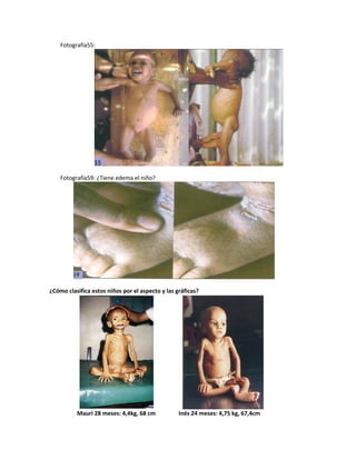 Fotografía55:
Fotografía59: ¿Tiene edema el niño?
¿Cómo clasifica estos niños por el aspecto y las gráficas?
Mauri 28 meses: 4,4kg, 68 cm Inés 24 meses: 4,75 kg, 67,4cm
 