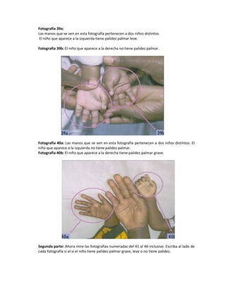 Fotografía 39a:
Las manos que se ven en esta fotografía pertenecen a dos niños distintos.
El niño que aparece a la izquierda tiene palidez palmar leve.
Fotografía 39b: El niño que aparece a la derecha no tiene palidez palmar.
Fotografía 40a: Las manos que se ven en esta fotografía pertenecen a dos niños distintos. El
niño que aparece a la izquierda no tiene palidez palmar.
Fotografía 40b: El niño que aparece a la derecha tiene palidez palmar grave.
Segunda parte: Ahora mire las fotografías numeradas del 41 al 46 inclusive. Escriba al lado de
cada fotografía si el si el niño tiene palidez palmar grave, leve o no tiene palidez.
 